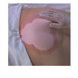 MEDICAZIONE IDROCELLULARE ADESIVA STERILE CONFORMATA PER LA REGIONE SACRALE ASSORBENTE IN SCHIUMA DI POLIURETANO ALLEVYN SACRUM 22,5X22,1CM 10PZ - Farmacia Mortise